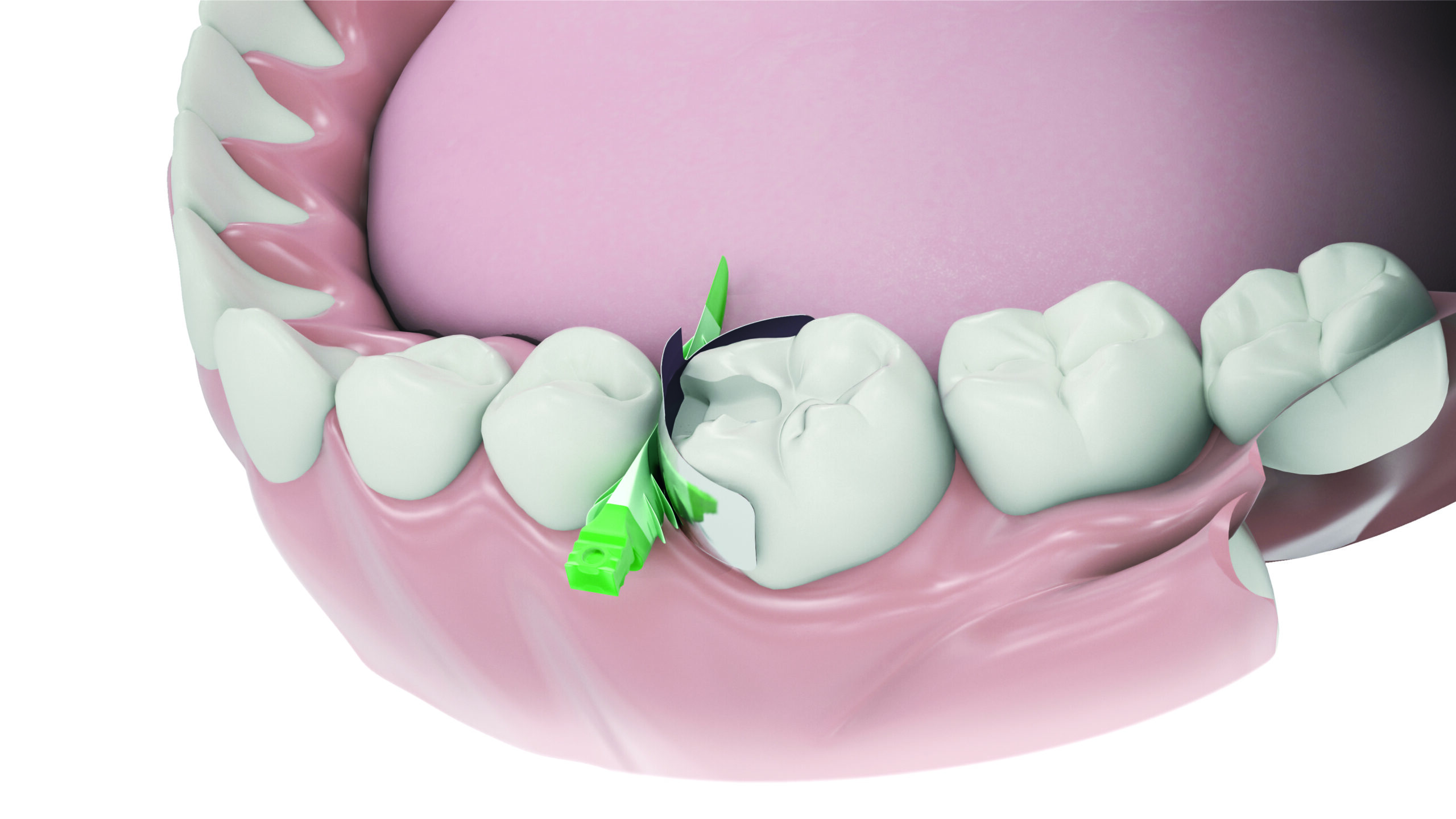 NITIN FULL CURVE MATRIX BANDS - Görsel 2